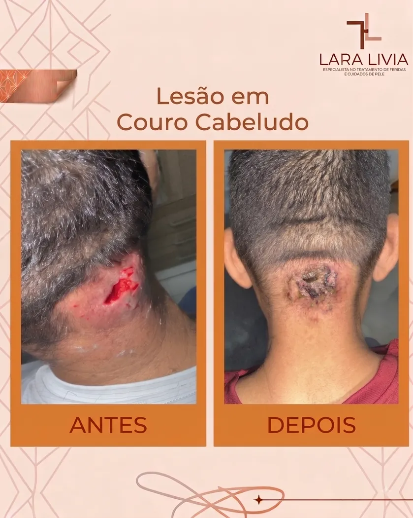 Antes e depois — lesão em couro cabeludo, caso tratado pela Enf. Lara Lívia em Mossoró – RN