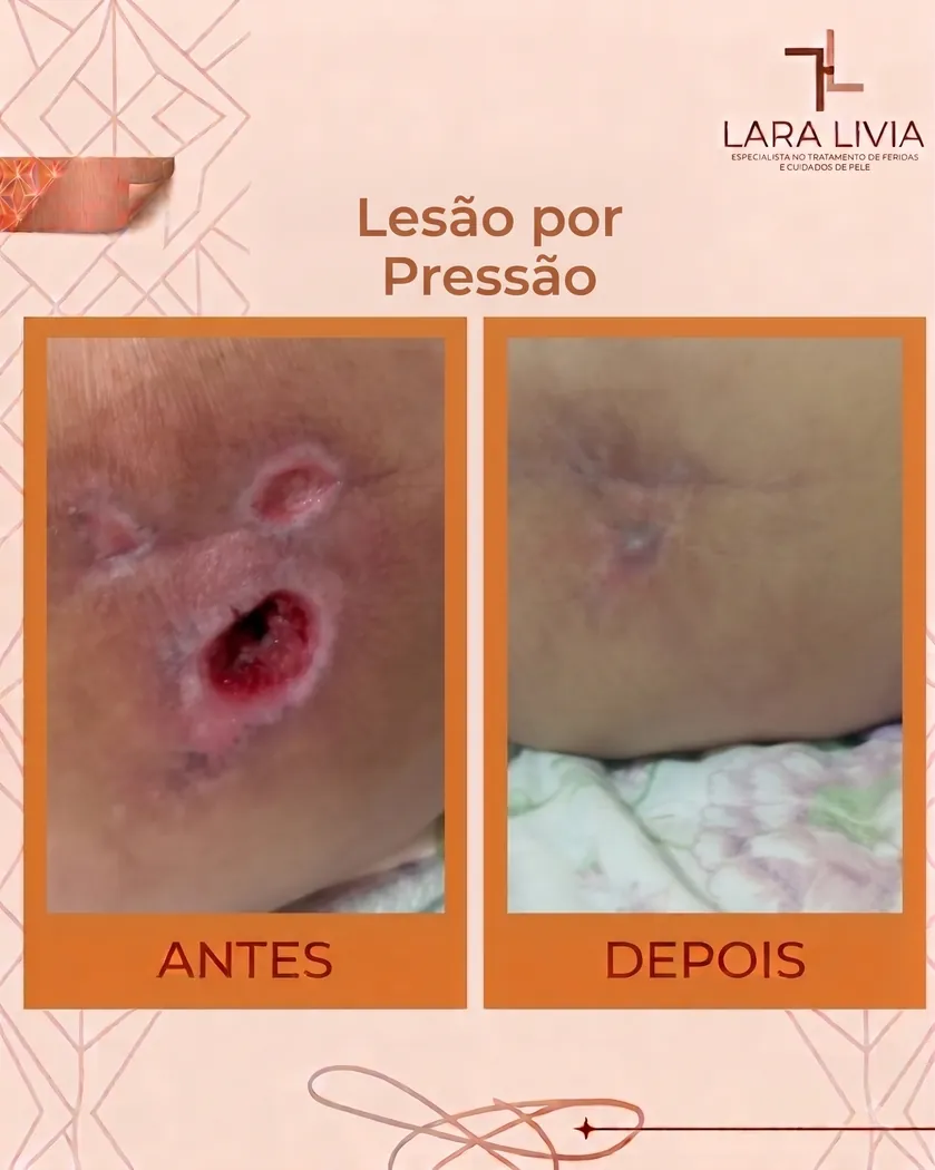 Antes e depois — lesão por pressão, caso tratado pela Enf. Lara Lívia em Mossoró – RN