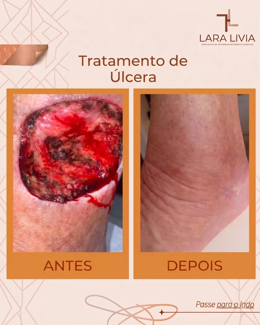 Antes e depois — tratamento de úlcera, caso tratado pela Enf. Lara Lívia em Mossoró – RN